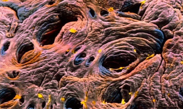 Celiachia nell'intestino