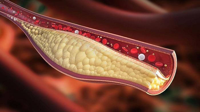 Colesterolo alto: la dieta giusta può sostituire i farmaci, dice uno studio