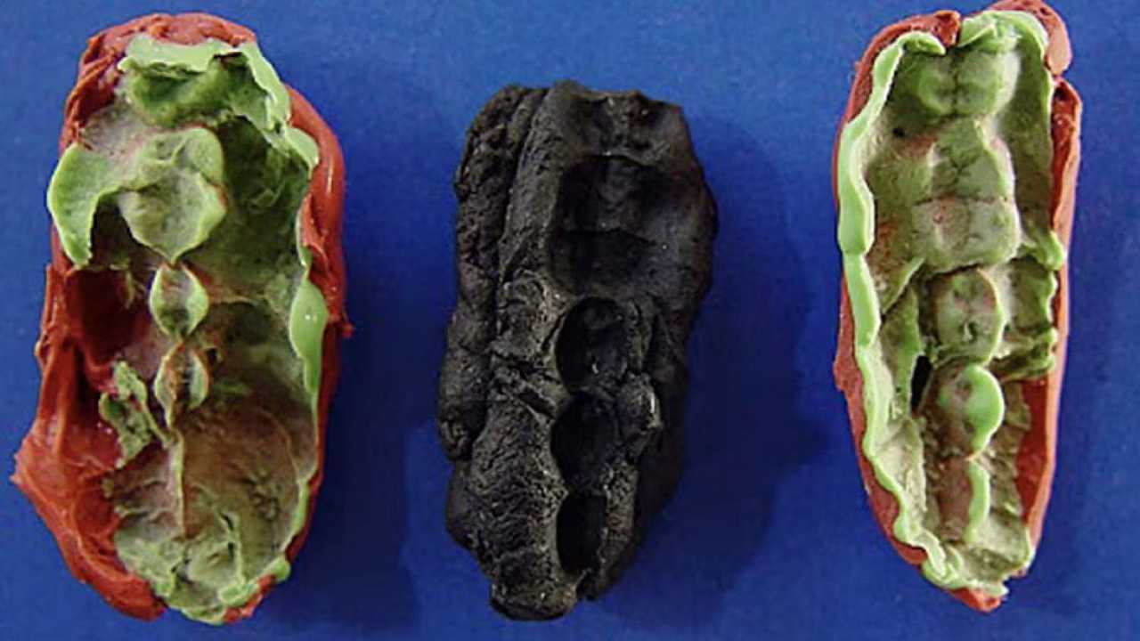 Trovata una “gomma da masticare” di diecimila anni fa