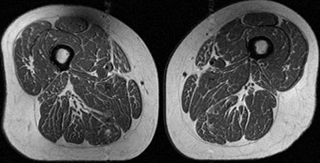 risonanza magnetica coscia 62 enne